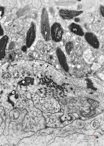 M,6m. | maxilla - melanotic progonoma (melanotic neuroectodermal tumor of infancy) M,6m. | maxilla - melanotic progonoma (melanotic neuroectodermal tumor of infancy)